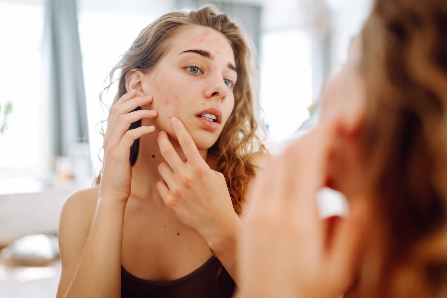 Could Your Gut Helth Actually Be What's Causing Acne?